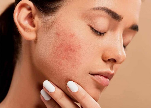 Best Acne Treatment Products