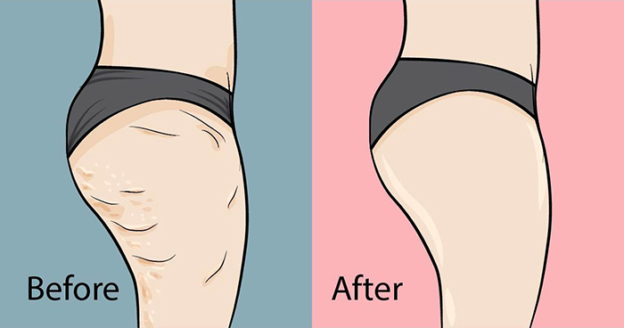 cellulite before and after