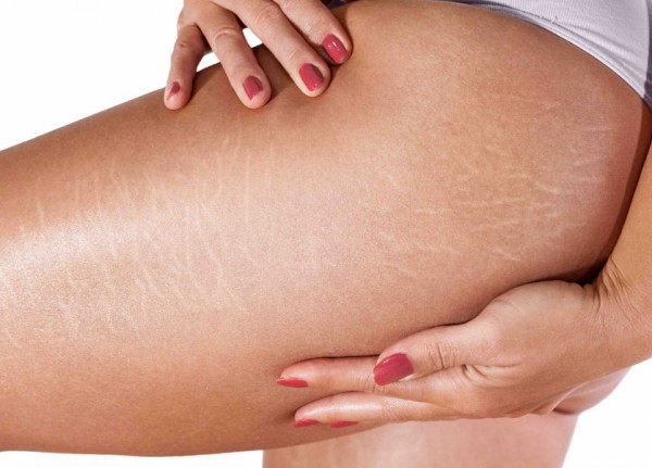 4 Effective Products to Minimize The Appearance of Stretch Marks